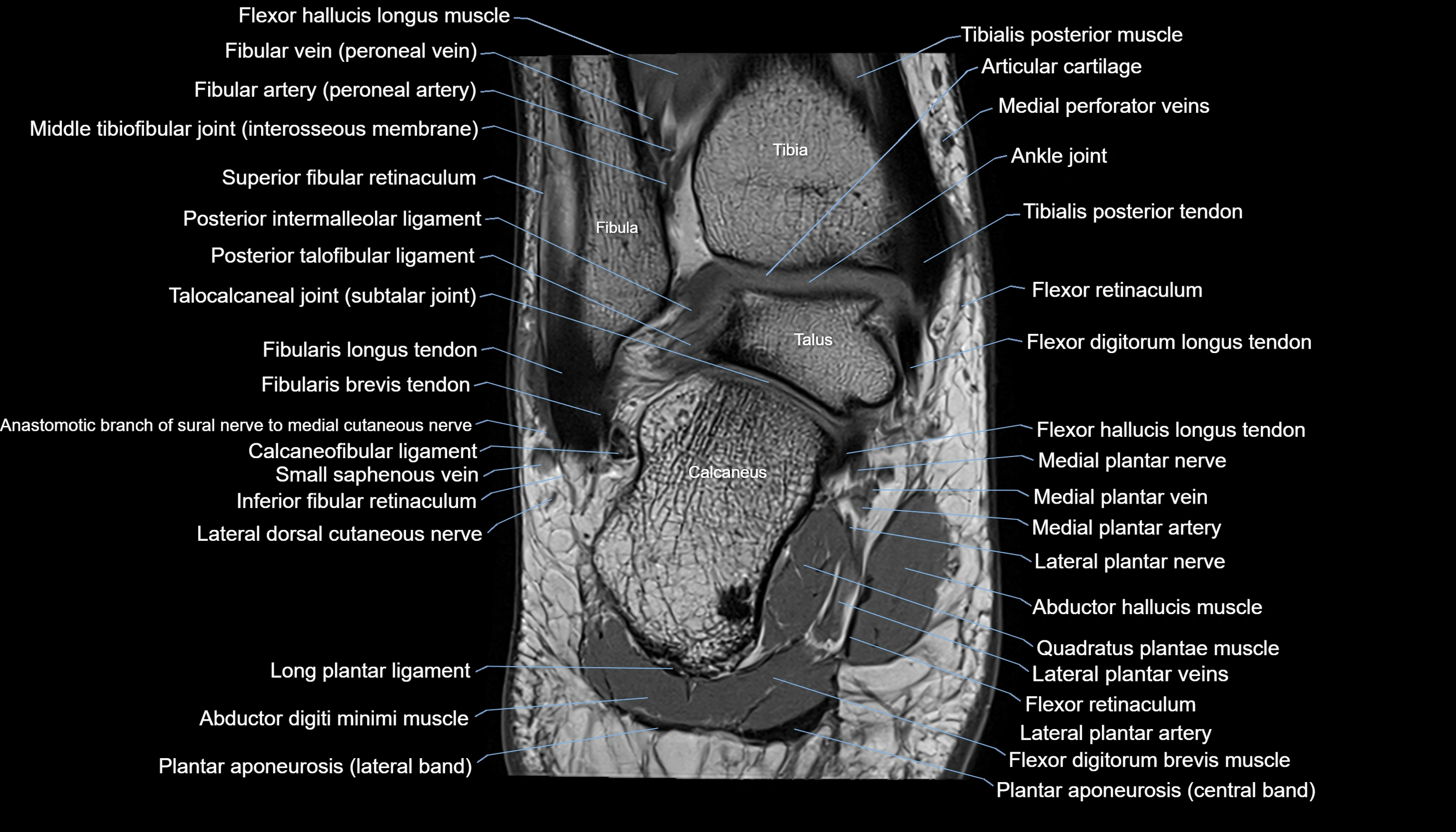 Ankle coronal anatomy 3T MRI images -img-11001-00017.webp